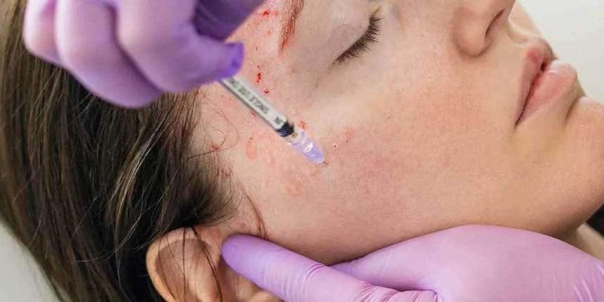 Key Considerations Before Undergoing a Vampire Facial Treatment