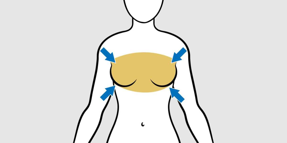 Addressing Recurrence After Breast Reduction Surgery