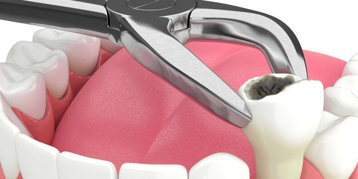 Rapid Relief: Expert Emergency Tooth Extraction in Santa Rosa by CA Dental Surgeons