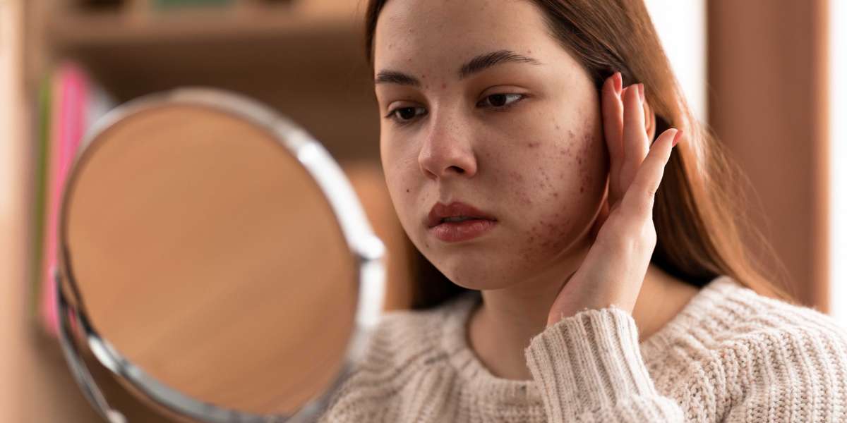 What Are the Most Effective Acne Scar Treatments?