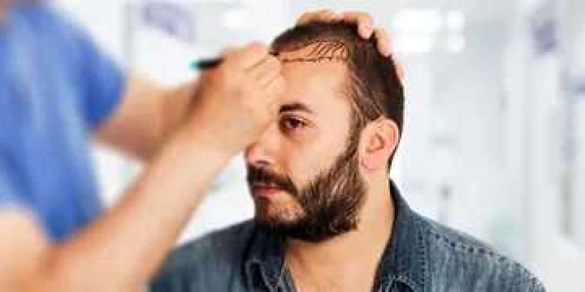 Advanced Hair Transplant Technologies in Sharjah