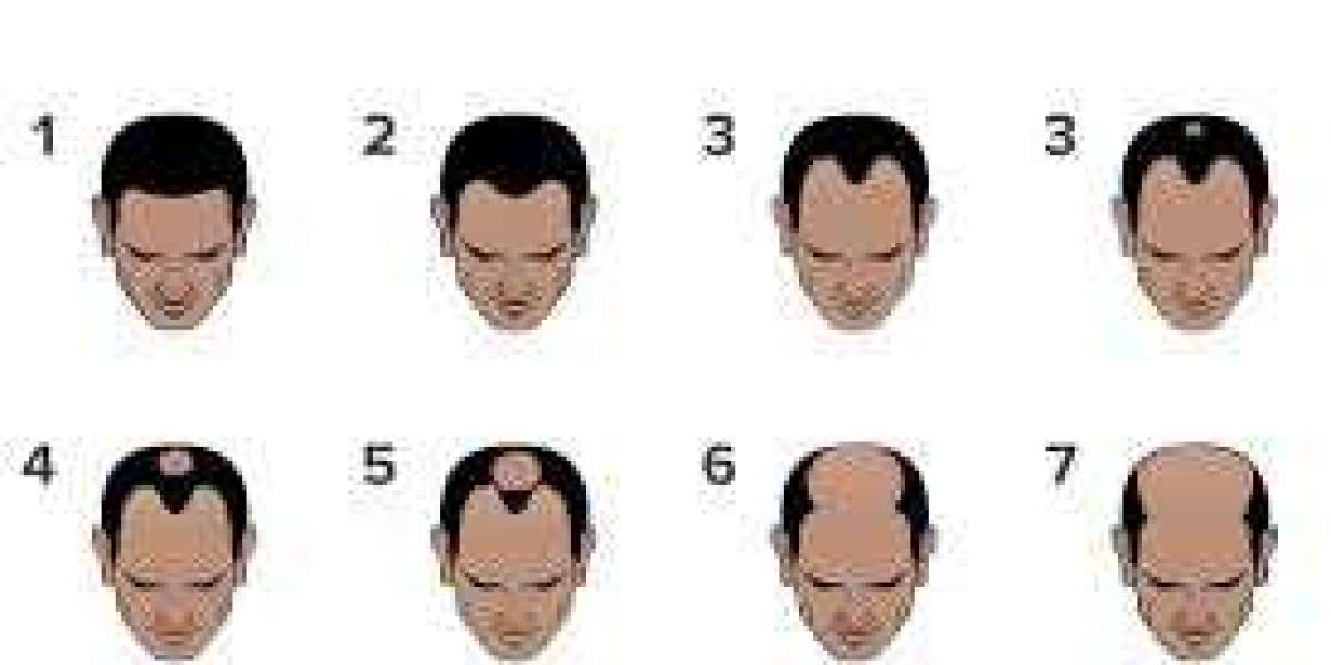 Stage 2 Hair Loss Treatment