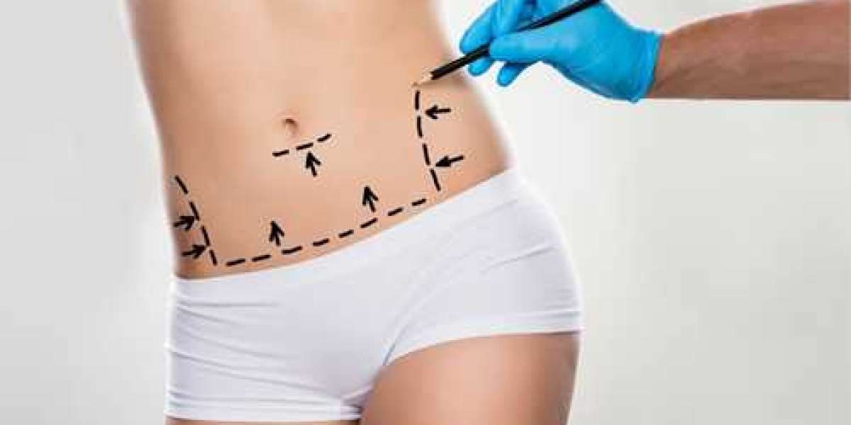 Laser Liposuction: Dubai Approach to Body Contouring