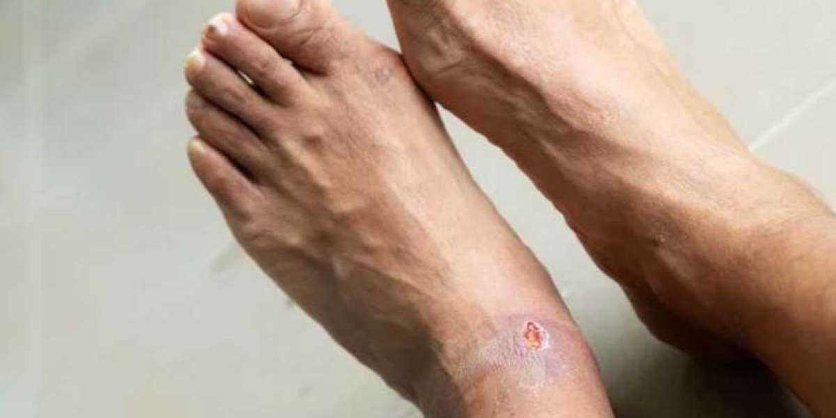 Diabetic Foot Ulcers Market | Share | Analysis | Growth | Reports | Forecast | 2024 - 2032