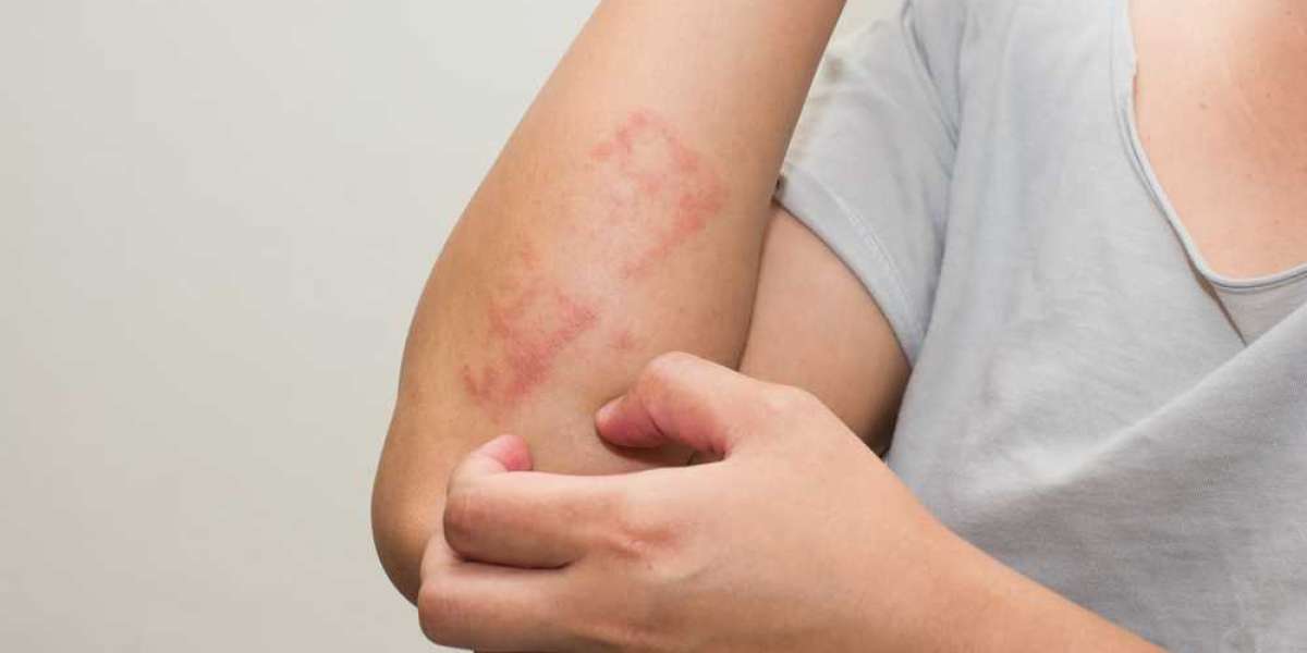 Best Skin Allergy Treatment at Jaya Skin Clinic