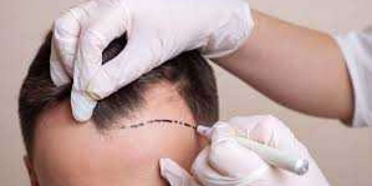 From Consultation to Transformation: London’s Hair Transplant Expertise Demystified