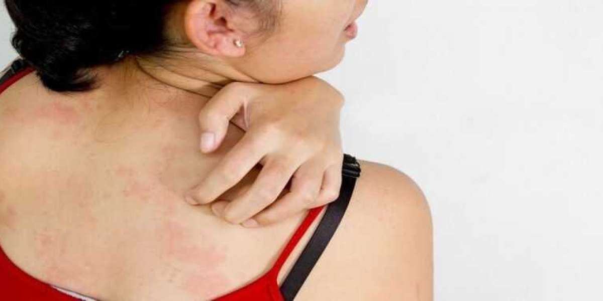 Skin Allergy Treatment - Jaya Skin Clinic