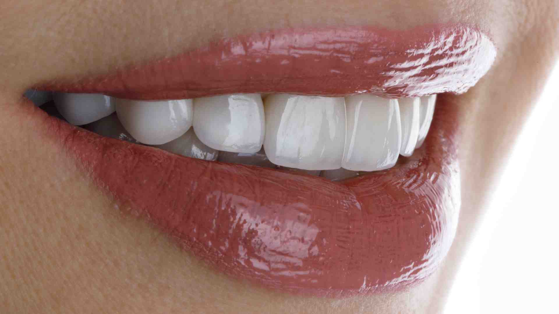 Dental Veneers