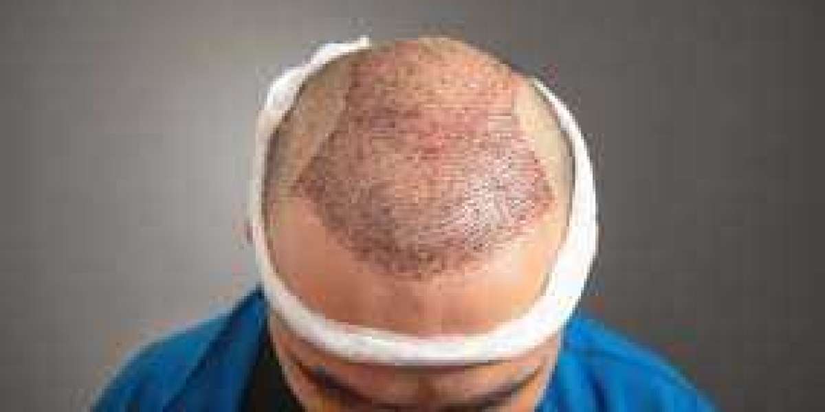 Regrow Your Hair, Redefine Your Look: Riyadh Hair Transplants