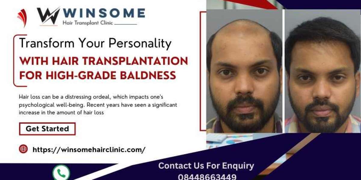 Transform Your Personality With Hair Transplantation For High-Grade Baldness