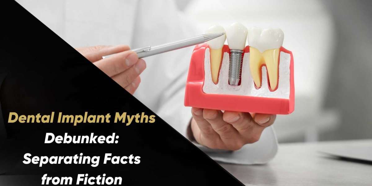 Dental Implant Myths Debunked: Separating Facts from Fiction