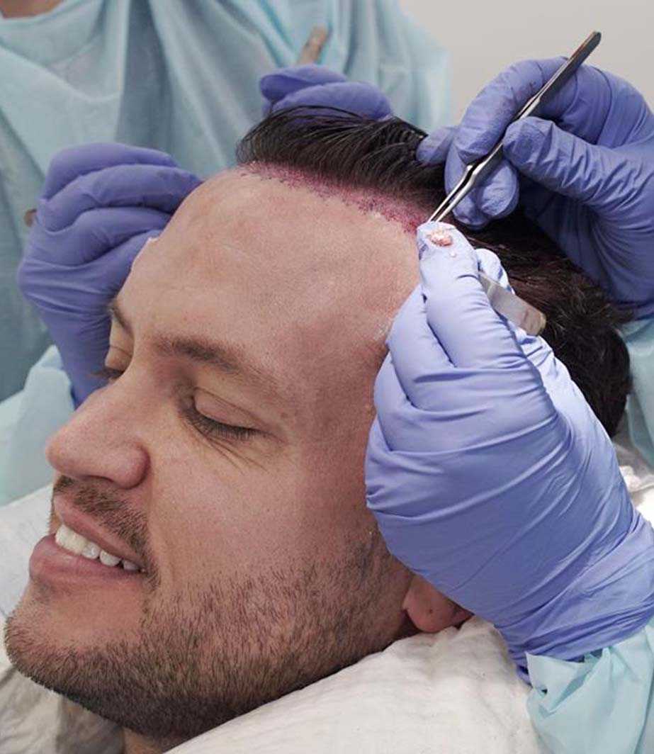 Hair Transplant in Dubai