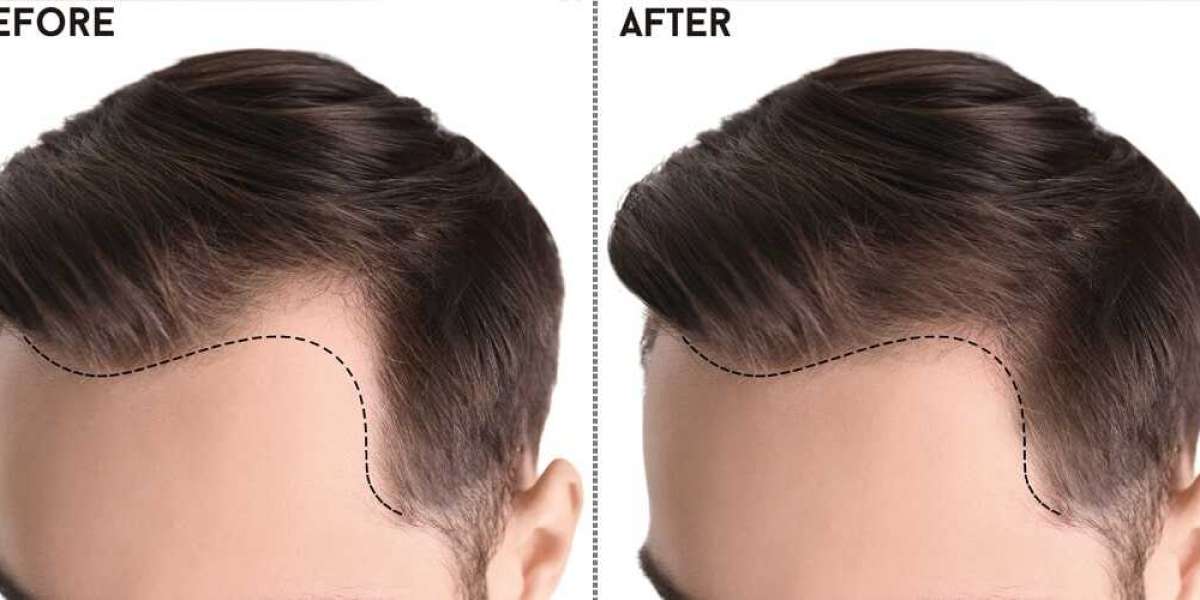 The Ultimate Guide to the Best Hair Transplants in Islamabad