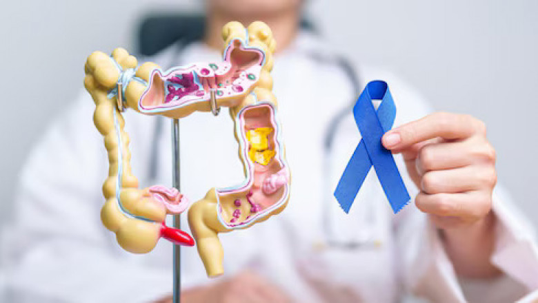 Where Can I Obtain The Best Treatment For Colon Cancer? | Times Square Reporter