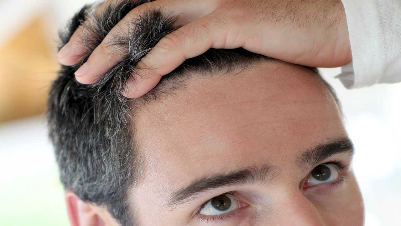 تكلفة زراعة الشعر في دبي