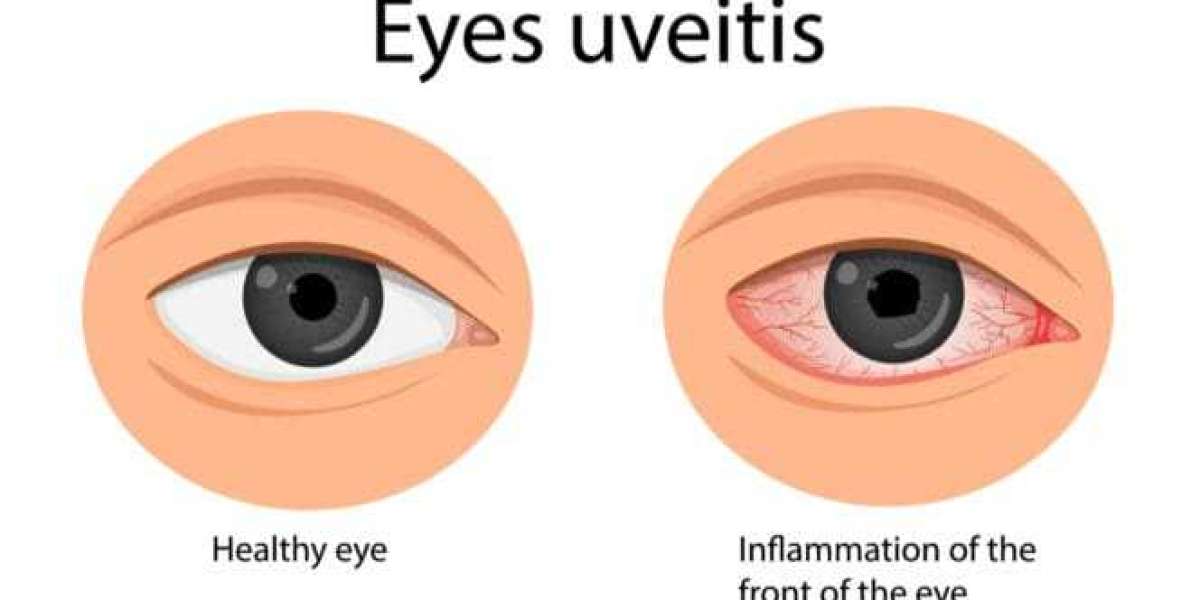 Uveitis Treatment Market Size, Evaluating Share, Trends, and Growth Forecast for 2024-2032