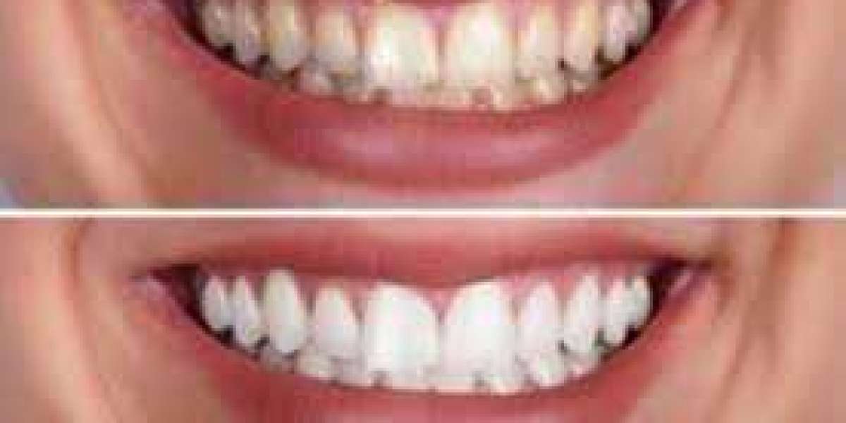 What Is the Best Teeth Whitening Treatment in London?