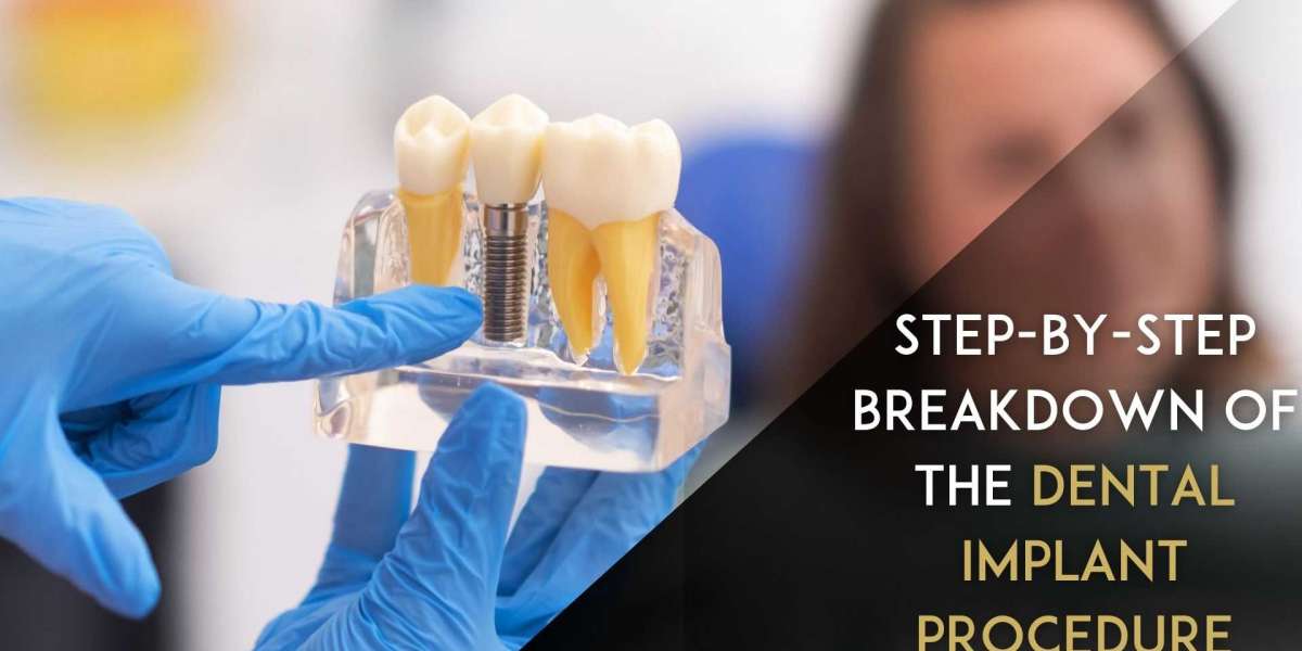 Step-by-Step Breakdown of the Dental Implant Procedure