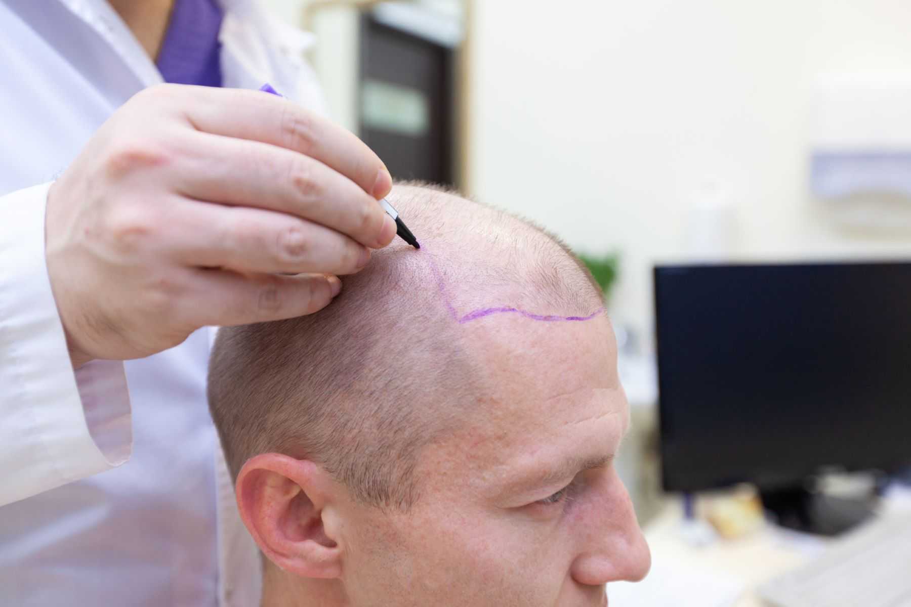 تكلفة زراعة الشعر 