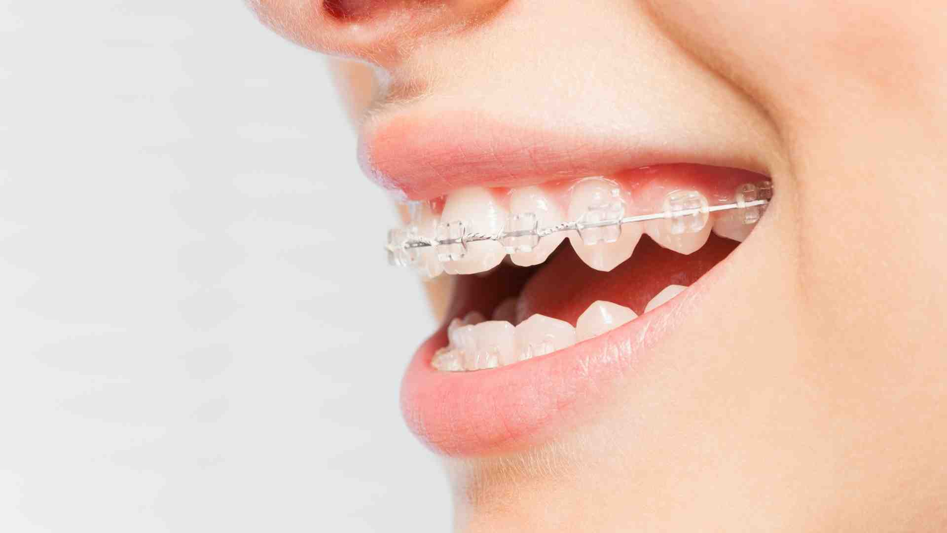 Specialized Care for Braces or Dental Appliances