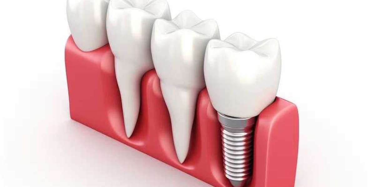 Dental Implants in Perth: The Ultimate Smile Restoration Solution