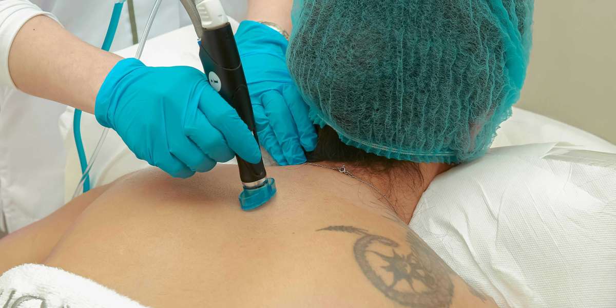 Tattoo Removal Cost in Pune: A Comprehensive Guide