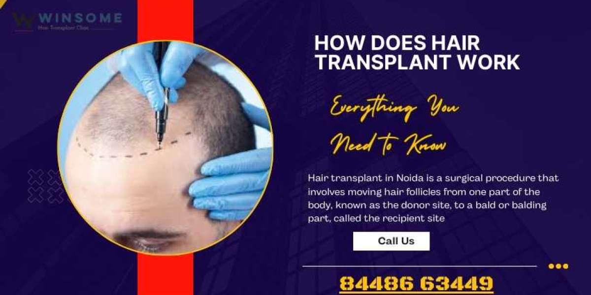 How Does Hair Transplant Work? Everything You Need to Know