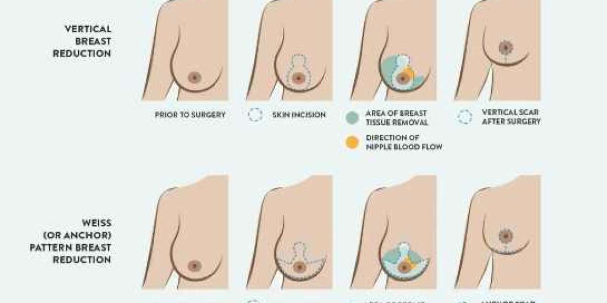 Breast Cancer Surgery in Pune - Choose Dr. Shilpy Dolas for precise and compassionate breast cancer surgery.