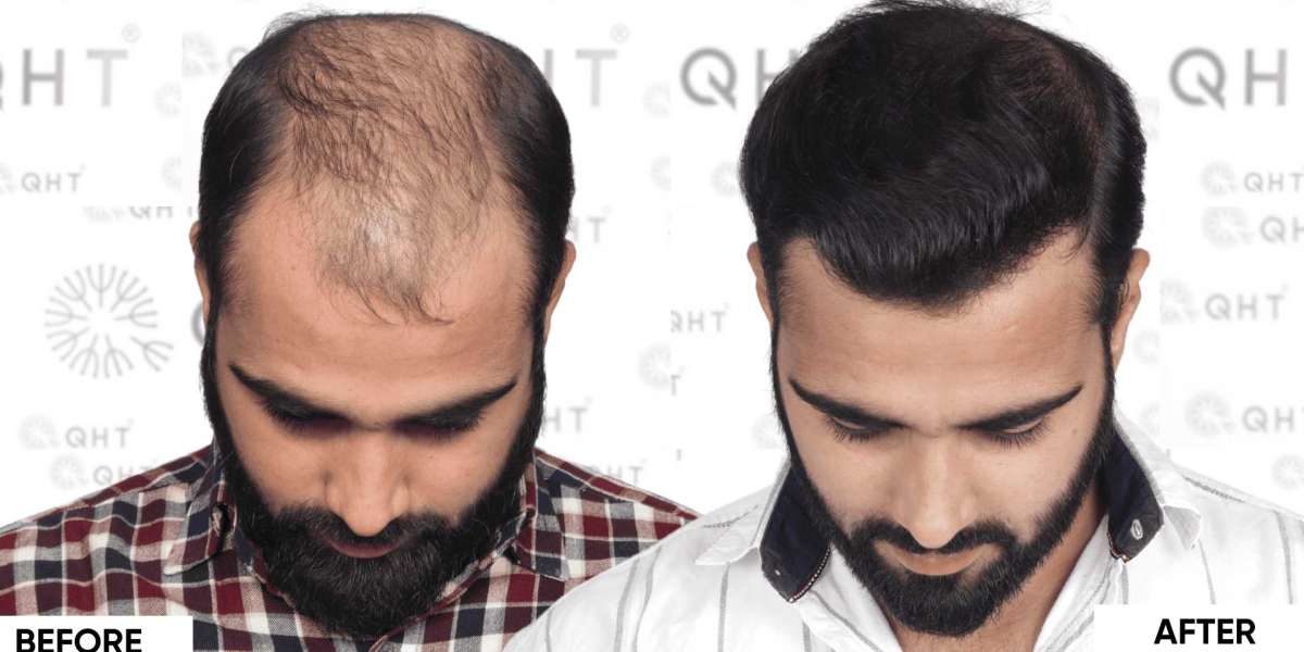 Best Hair Transplant Clinic in India: QHT Clinic