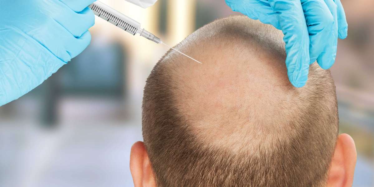 Transform Your Look with Expert Hair Transplant in Jodhpur at IFT Hair Science