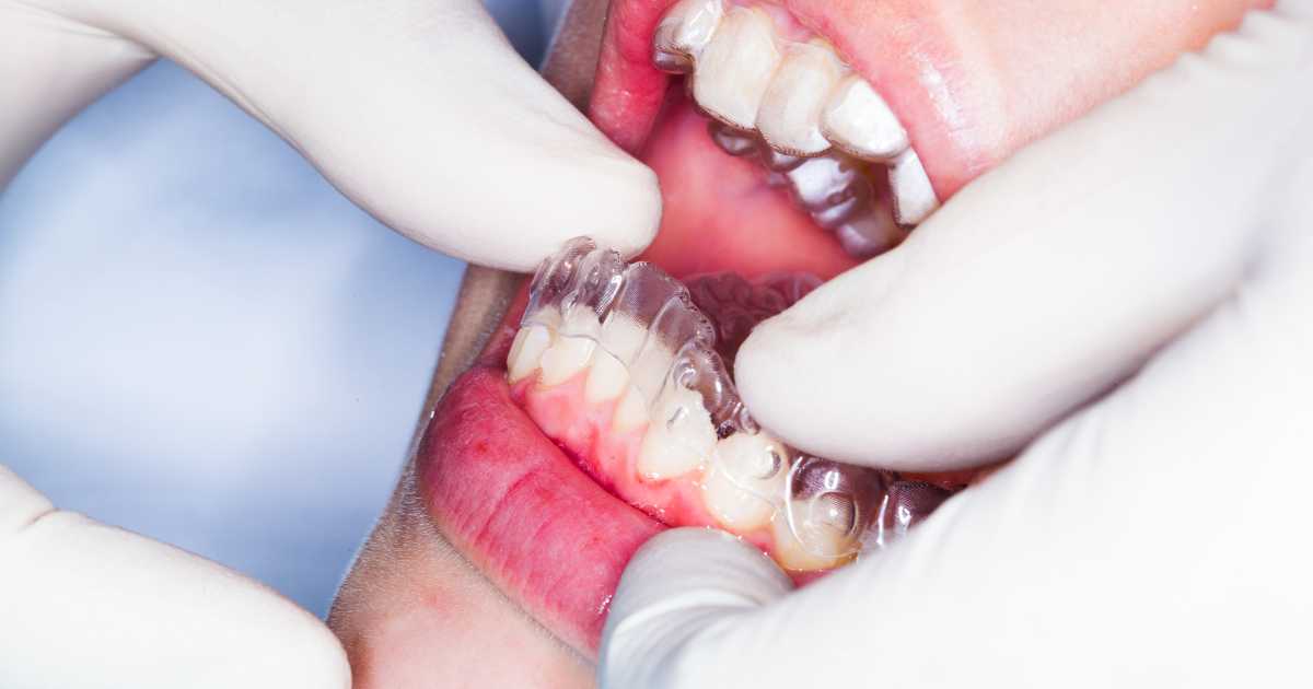 How Orthodontic Services Impact Long-Term Oral Health