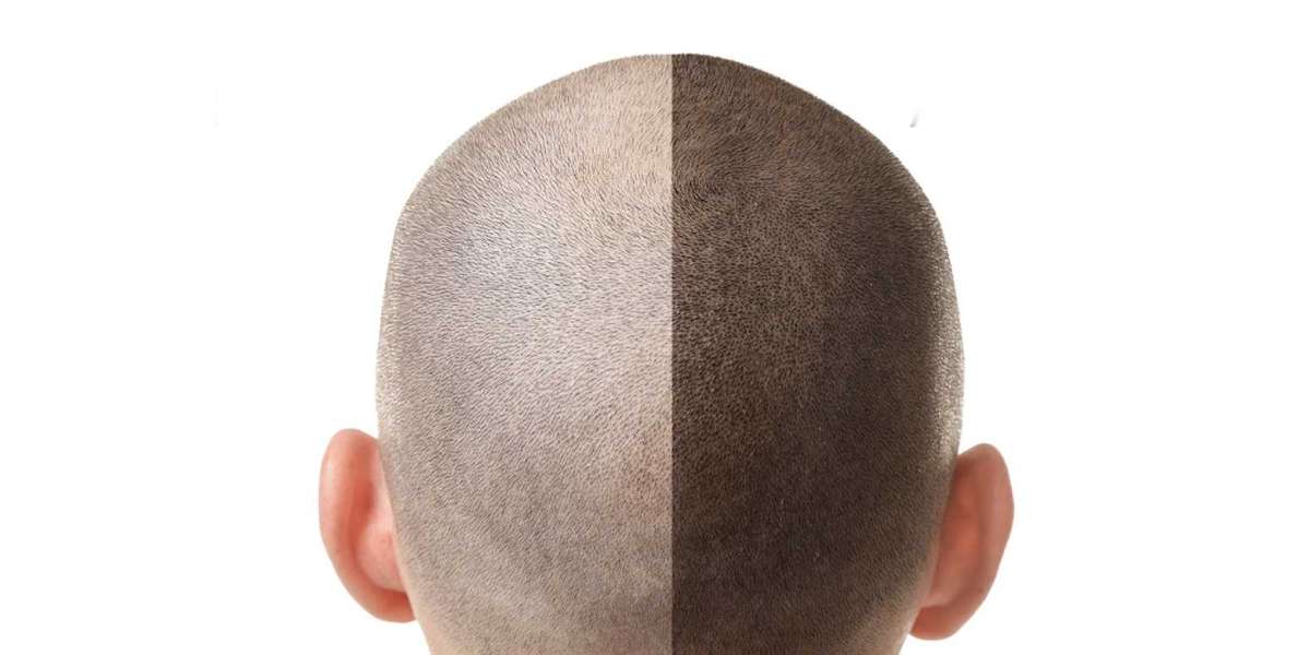 Affordable Hair Transplant Options in Delhi