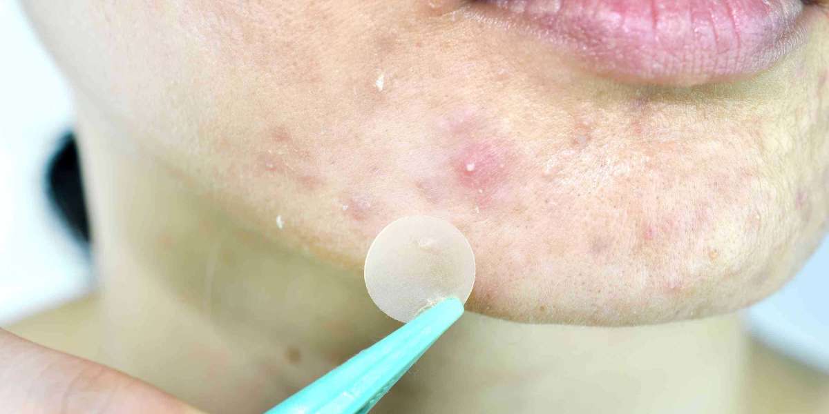 Hydrocolloid Acne Patch: A Revolutionary Solution for Acne Treatment