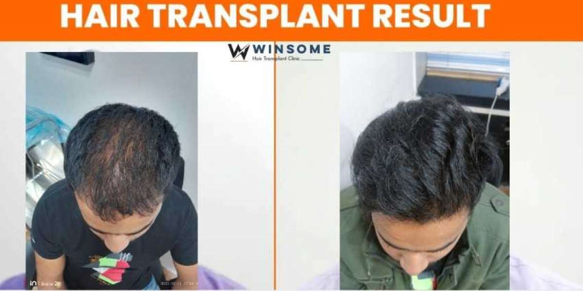 The Best Way To Avoid Side Effects After Hair Transplantation