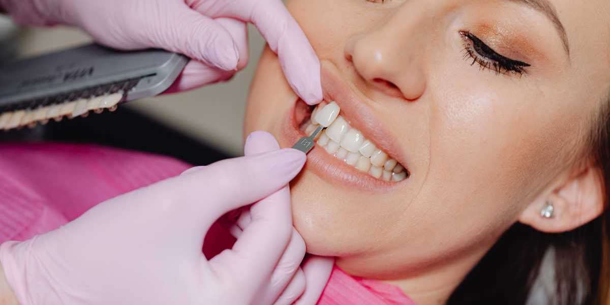 10 Things to Know Before Getting Veneers