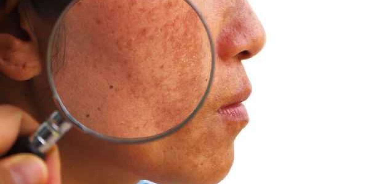 How Pigmentation Treatment Kits Work: Benefits, Ingredients, and Tips