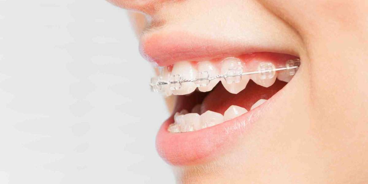 The Best Clear Aligners for Fast, Effective Teeth Straightening