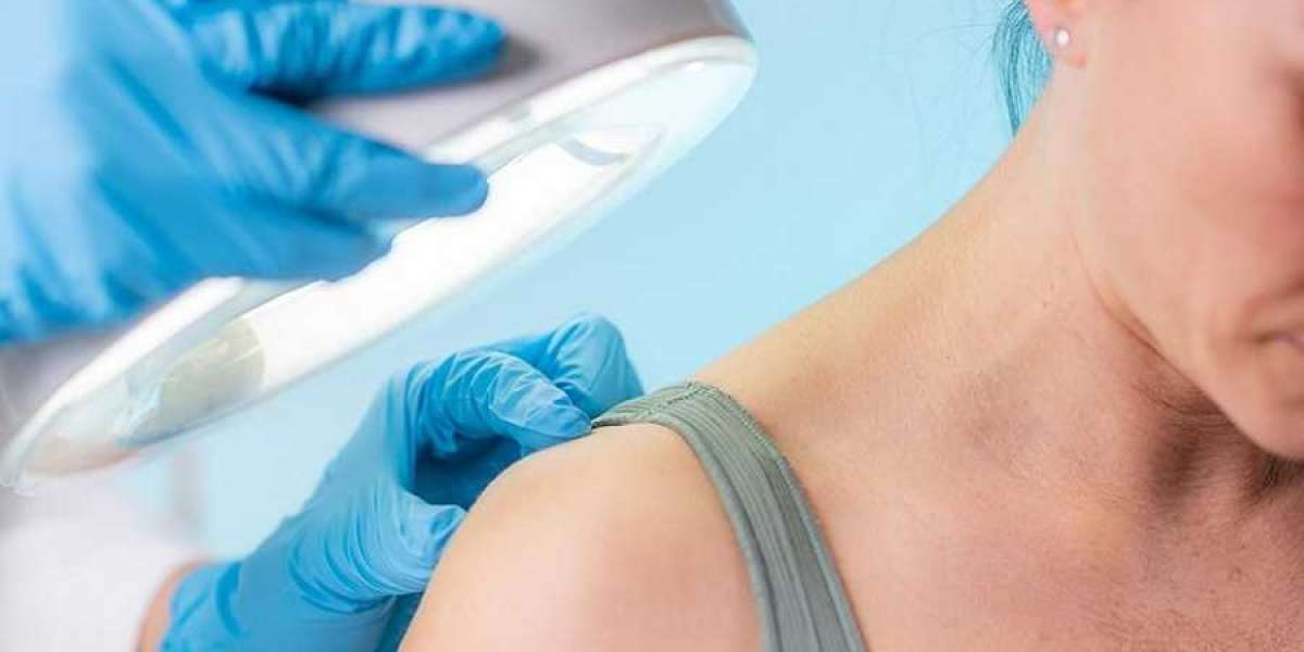 Wart Removal for Sensitive Skin: Best Treatments in Islamabad