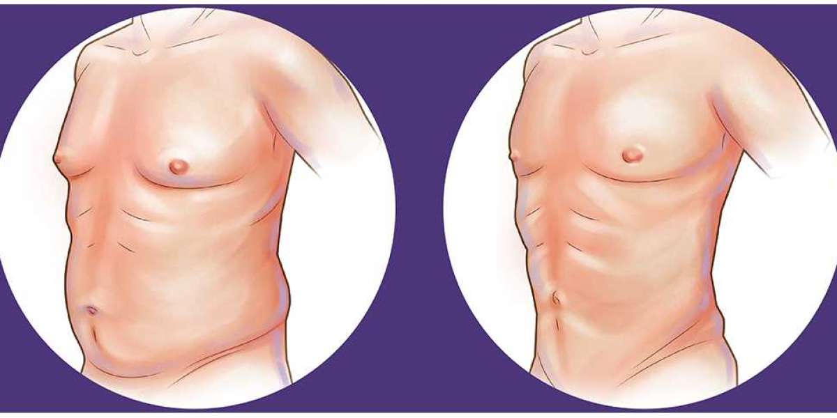 Liposuction Cost in India