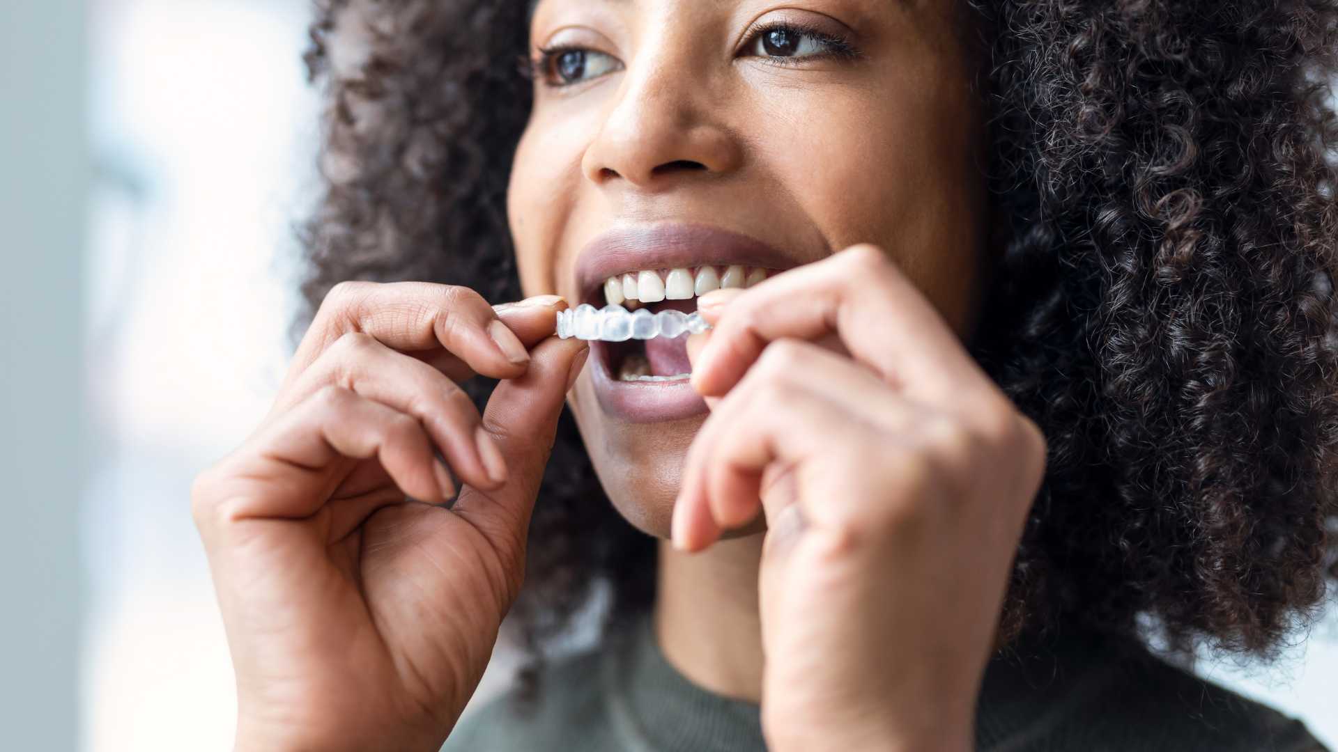 Removable Aligners for Convenience