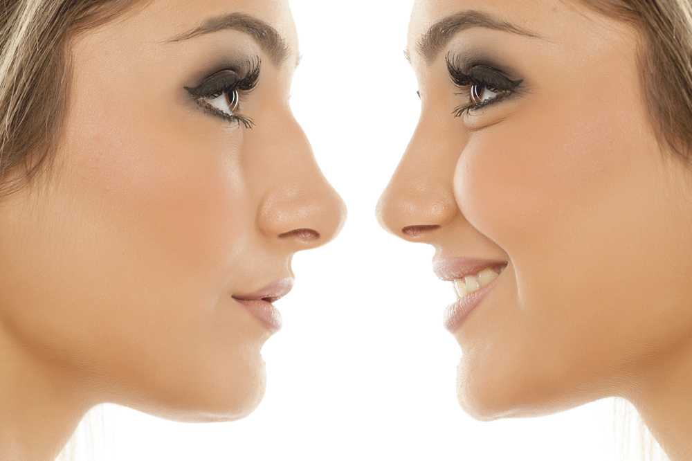 Rhinoplasty Dubai