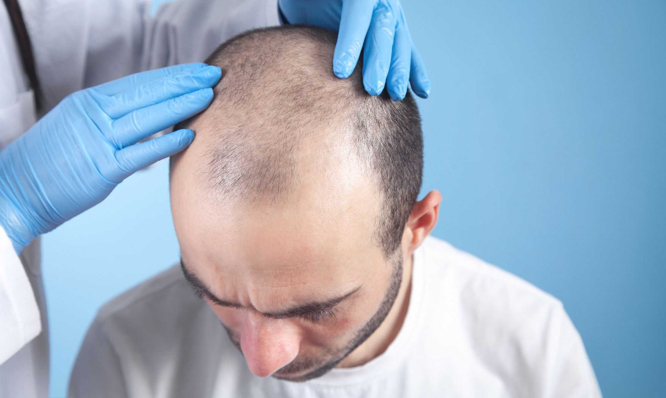 Hair transplant in Dubai