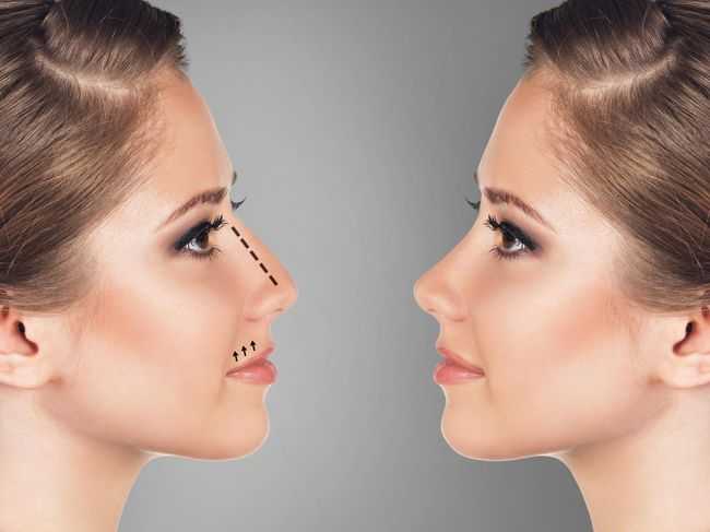 Rhinoplasty Dubai