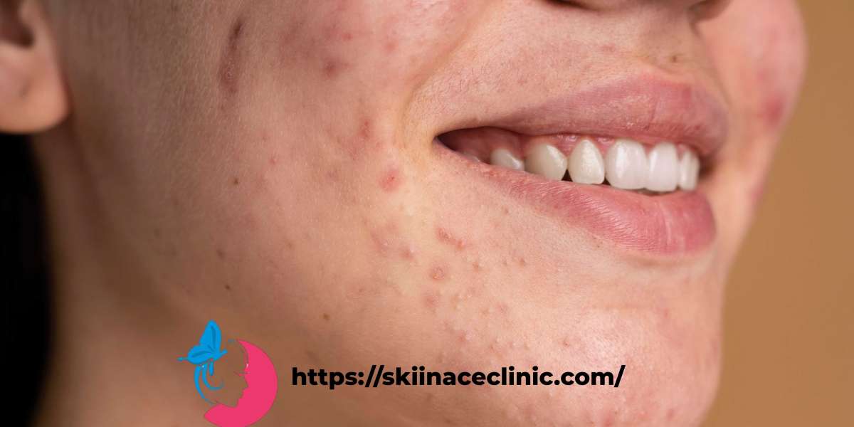 Acne Scar Treatment in Bandra: Achieve Clear, Smooth Skin at Skiin Ace Clinic