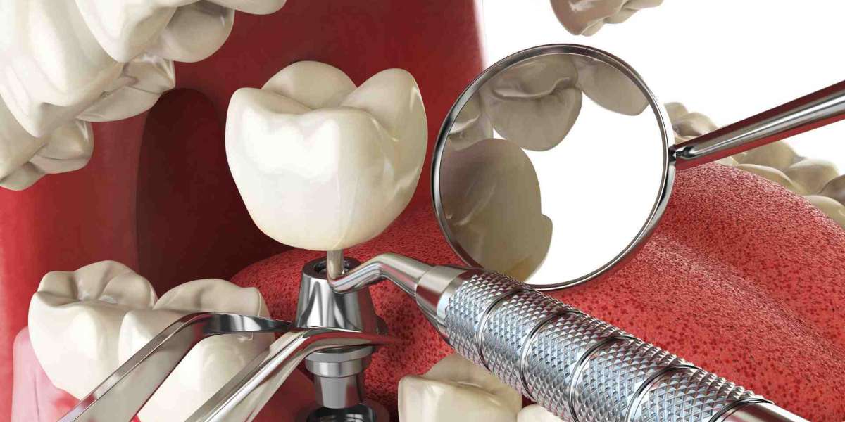 Debunking Popular Dental Implant Myths