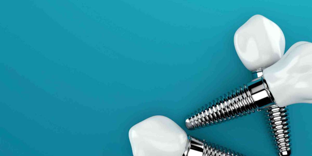 Implant Benefits for a Better Smile