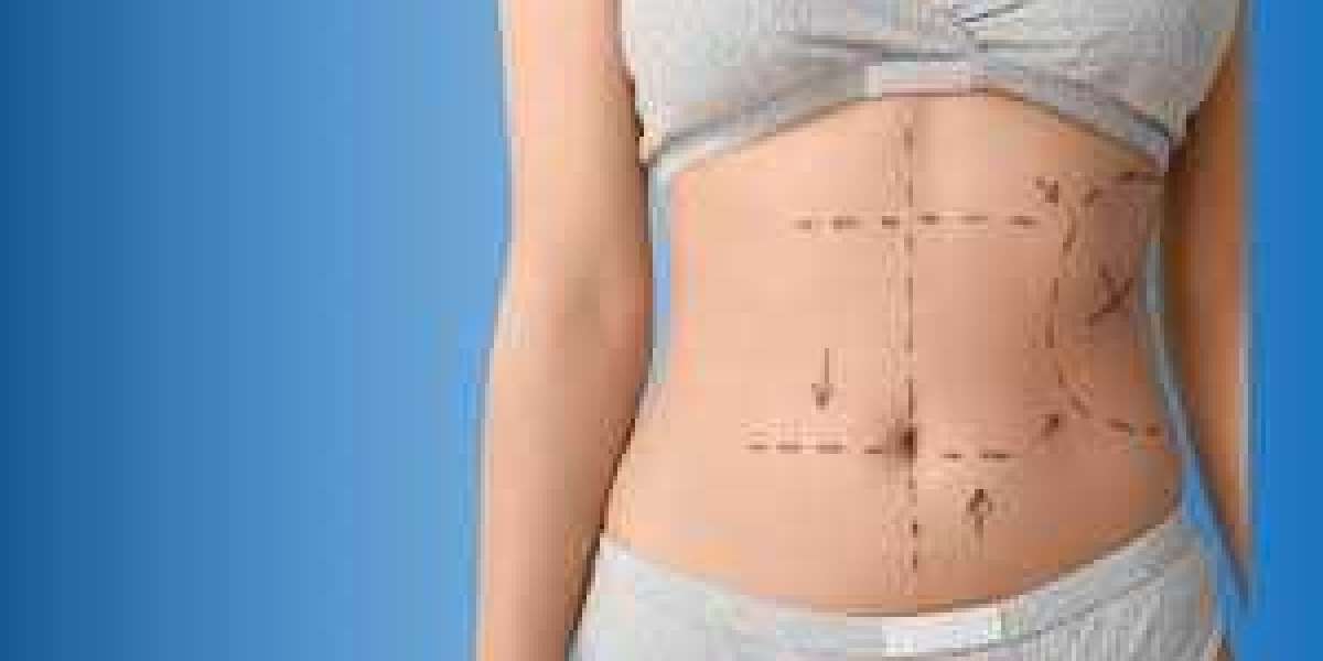 Abdominoplasty in Raleigh, NC – Sculpt & Tighten Your Midsection