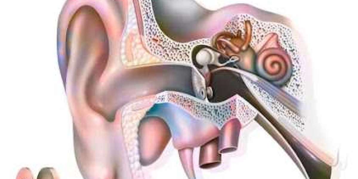 Myringotomy for Otitis Media: A Proven Treatment for Fluid Buildup