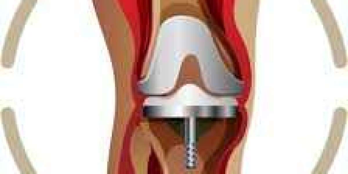 Total Knee Replacement Surgery Treatment