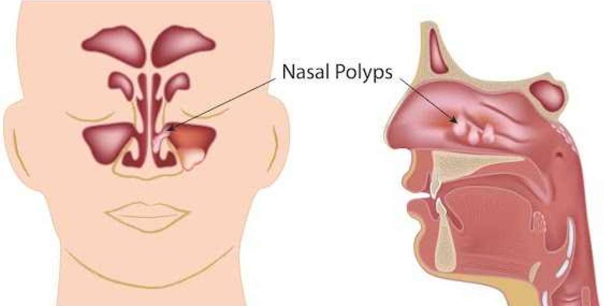 Expert Nasal Polyp Treatment at Veekay Clinic – Best ENT Care in Gurgaon